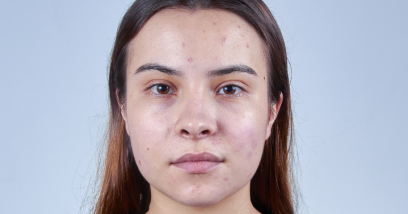 Masna koža i akne: Vodič za negu